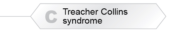 The Answer Is C - Treacher Collins syndrome